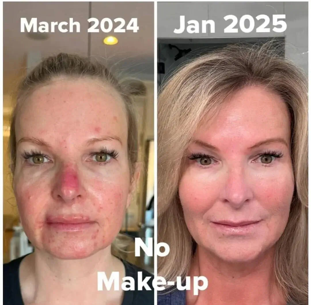 Before and after transformation showing skin improvements with snail repair skincare pads, no makeup, from March 2024 to January 2025.