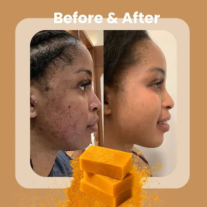 Belenora™ Turmeric Soap