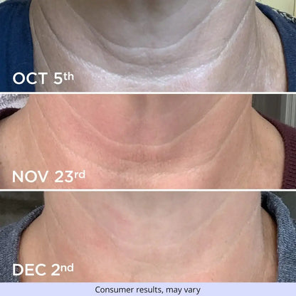 October to December neck skincare comparison showing changes in the appearance of neck lines, skin texture and firmness.