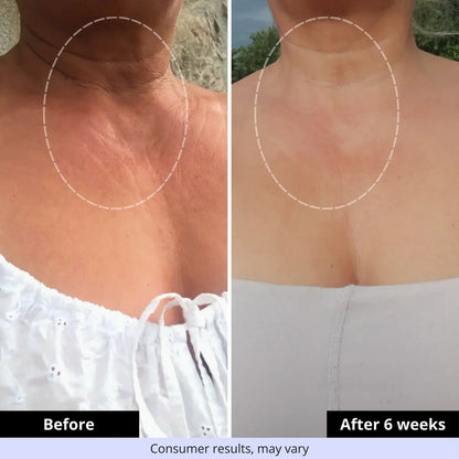 Before and after comparison illustrating smoother-looking neck skin and reduced appearance of wrinkles with AgeErase Neck Cream.